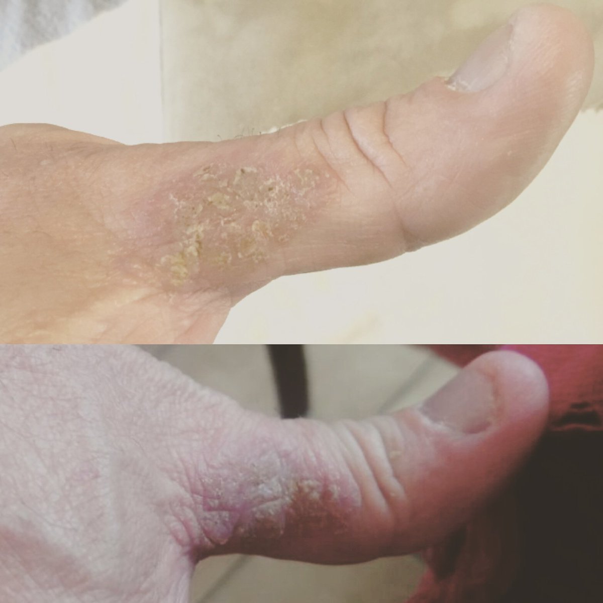 A client's psoriasis patch after 
1 cryo treatment.Notice skin colour changing, some scabs  falling off.Normal skin cells will form to heal the patch.
Soothes eczema&amp;psoriasis
Especially during winter ❄❄
#Cryo #cryotherapy #psoriasis #eczema #dryskin #pretoria #southafrica