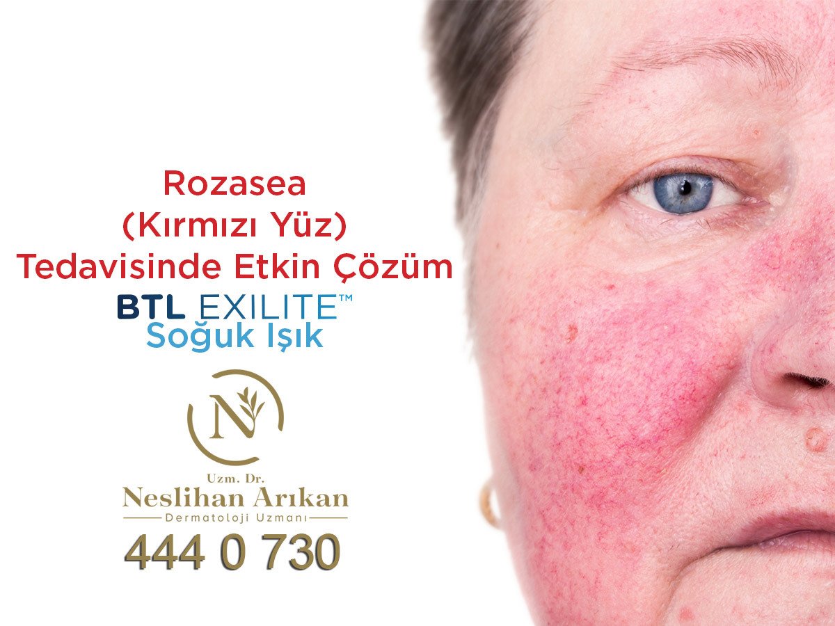 Gül hastalığı nedir Tedavisi var mıdır Gül hastalığı nedir Tedavisi var mıdır