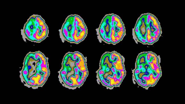 What could cause #epilepsy in children?: Further reading here: buff.ly/2IJETRF