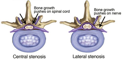WallaceNilanPT's tweet photo. The More You Know: Spinal Stenosis

"It is estimated that as many as 80% of us will experience some form of back or neck pain at some point in our lifetimes." - @APTAtweets #themoreyouknow #getPT1st #physicaltherapy

https://t.co/E6rElipglA https://t.co/impIB2AyTH