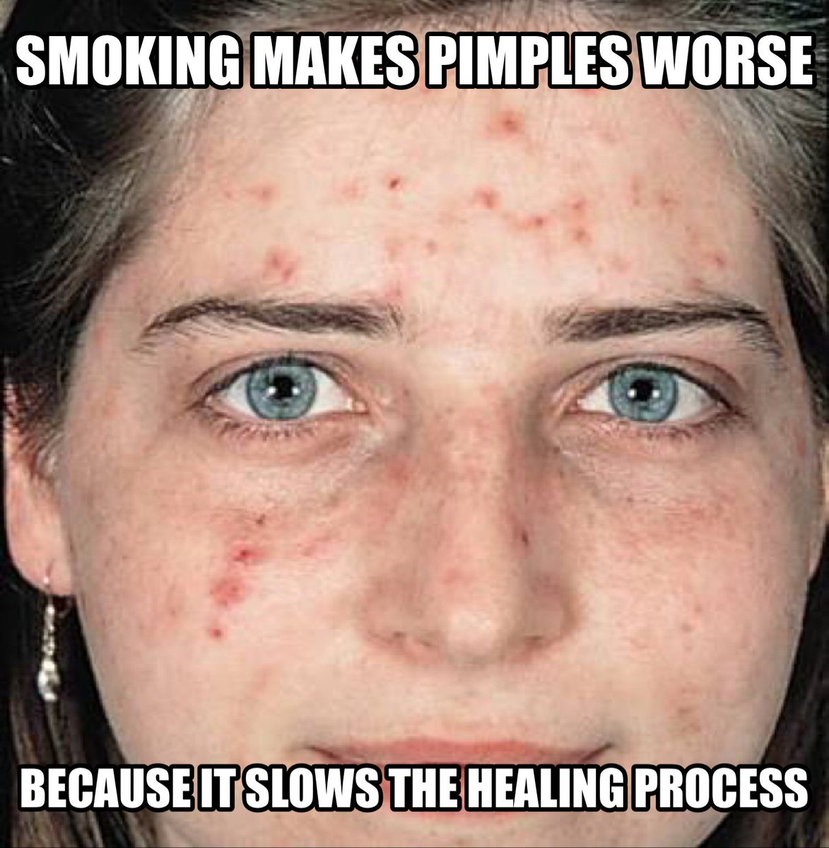 KicktheButtAust's tweet photo. Help your skin heal, stay smoke free #kickthebutt https://t.co/1tPJq3Bs0M
