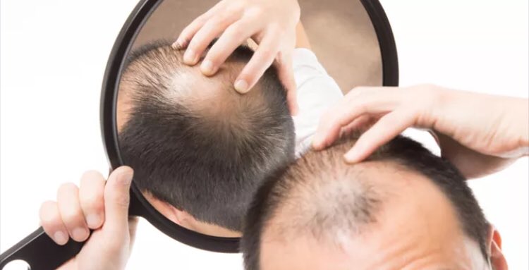 thymuskinsa's tweet photo. Topless not by choice. #hairloss #hairlosssolution #hairlosshelp #hair #alopecia #thymuskin #menshair #medicalaesthetics https://t.co/c53NP0CuLG
