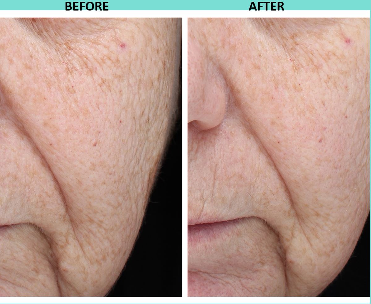nowmi_treatment's tweet image. Want to get rid of fine lines? With NowMi after only 6 treatments you can see a significant improvement.  Each treatment took only 5 minutes, making the treatment ideal for individuals with busy schedules. ow.ly/lC7l30jDZDG
