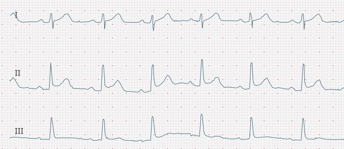 ecgbuddy's tweet photo. 23y/o male patient was admitted to the hospital in critical condition 3 days ago. The patient has now been transferred to your floor. What's the medical problem of this young patient?#ECG #ecgbuddy #studybuddy #doctopia #ecg #ecginterpretation #ecgreading #ecgcourse #hospitallife https://t.co/48UAtqDbTa