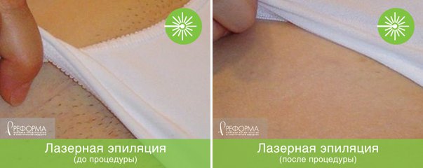 MyRefforma's tweet photo. 😍 Идеально гладкая, ухоженная кожа – уже даже не вопрос, а обязательный пункт в летней программе.
⠀
👙💃Легкие платья, короткие шорты и юбки, соблазнительные бикини – носите то, что хочется, забыв о проблеме нежелательных волос НАВСЕГДА!
⠀
👌Лазерная… https://t.co/AN6BhC1wuR https://t.co/GSvTHOYuvC
