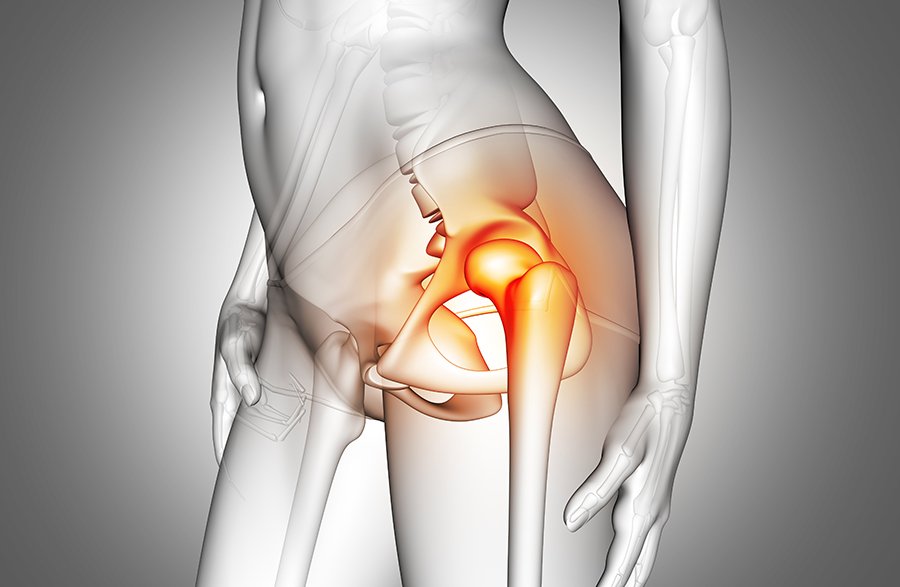 LA_PALESTRA_NET's tweet image. Quando si può tornare a praticare attività sportiva dopo un intervento chirurgico di protesi all’anca? E quali sono le attività praticabili? lapalestra.net/protesi-allanc… #anca #salute #protesianca #palestra