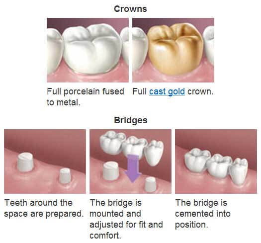 The purpose of a Crown or bridge is to protect badly broken or #damagedtooth without the need for its removal. To know more details visit our site or you can call us at 1-800-476-8416. bit.ly/2LYT5nO. 'We want you well.'