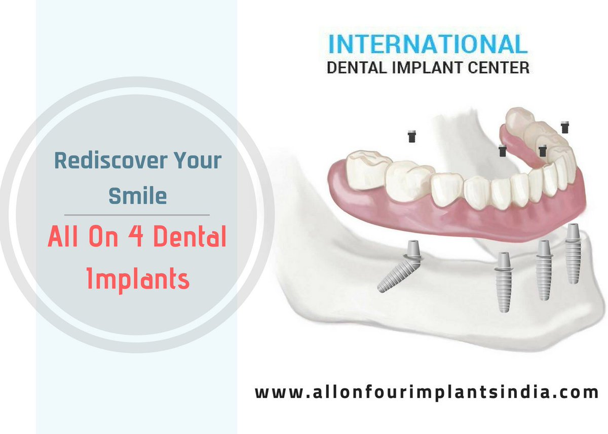 dr_murugavel's tweet photo. Thinking of Dental Implants?
Choose The All-On-4 Dental Implant Technique.
Make your appointment here: https://t.co/X5Auah1rYy
Avail this treatment: https://t.co/JI1NJo727b .
#DentalImplant #Dentistry #DentalCare #DentalHealth
#Chennai https://t.co/x3QqN2stsZ