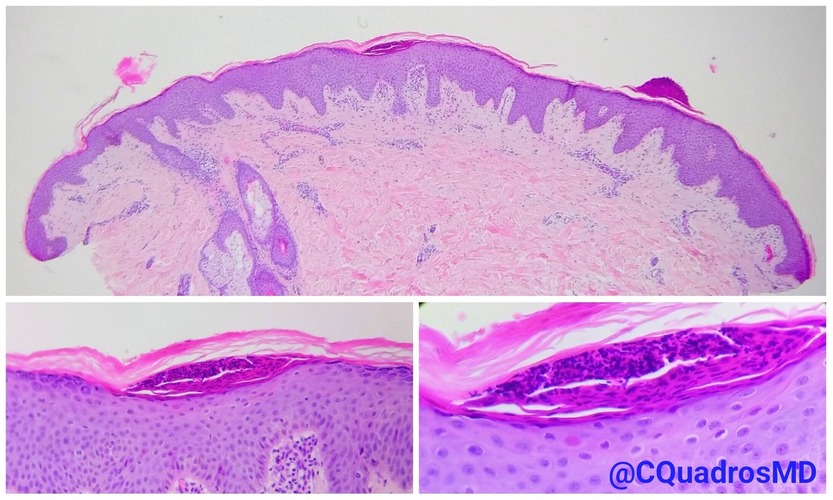 CQuadrosMD's tweet photo. Mounds of parakeratosis  with neutrophils + focal hypogranulosis + psoriasiform hyperplasia = Guttate psoriasis ⛰️ #pathology #dermpath #Dermatology https://t.co/4YyKxcMr6U