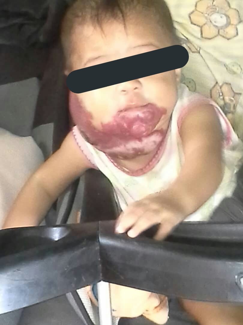 CiudadGuayanaFB's tweet image. #24Mayo #Guayana Se llama Noemi Farfan, tiene 6 meses, esta en Hospital Uyapar y presenta Hemangioma. Necesita: 

➡ OXASILINA 1mg 
➡AMIKACINA 1mg AMPOLLAS

Sus padres son de bajos recursos y apoyamos en lo que podemos. Si puedes por favor contacta: 04261918655 - 04249101035