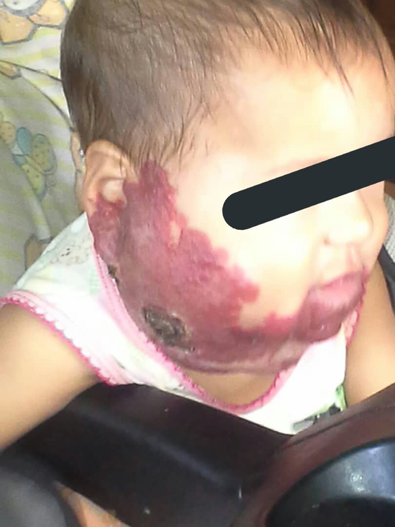 CiudadGuayanaFB's tweet image. #24Mayo #Guayana Se llama Noemi Farfan, tiene 6 meses, esta en Hospital Uyapar y presenta Hemangioma. Necesita: 

➡ OXASILINA 1mg 
➡AMIKACINA 1mg AMPOLLAS

Sus padres son de bajos recursos y apoyamos en lo que podemos. Si puedes por favor contacta: 04261918655 - 04249101035