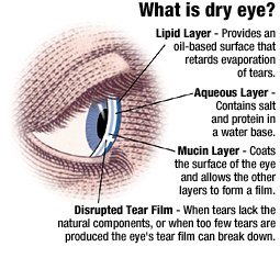 Assessment tool accurately identifies patients at risk for dry eye, a dry eye risk calculator, can help assess which patients might require testing and treatment to ensure appropriate eye performance and comfort throughout the day bit.ly/2IPRorb