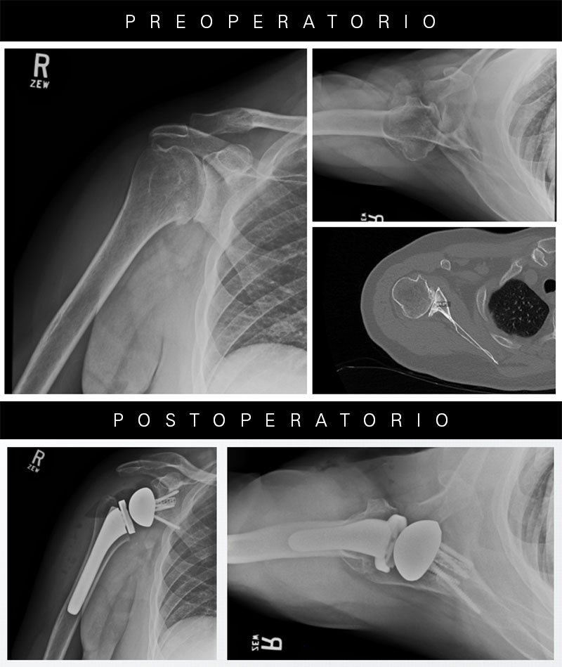 ExactechIberica's tweet photo. 🤔 ¿Cómo resolvemos la pérdida de hueso glenoidea? Aprende más en nuestro blog y accede al estudio completo publicado en @JSESMedia https://t.co/ceKWgiNyya #hombro #shoulder #artroplastia #glena #exactech #blog https://t.co/Ljv8Uz4w1n