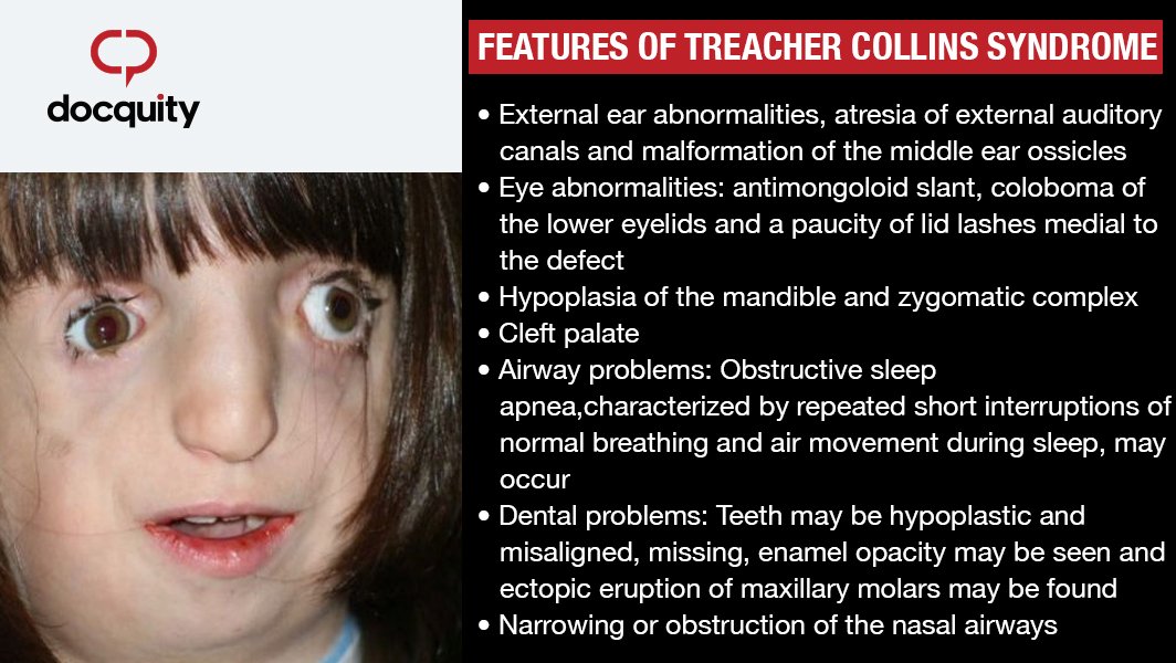 Treacher Collins Syndrome Symptoms