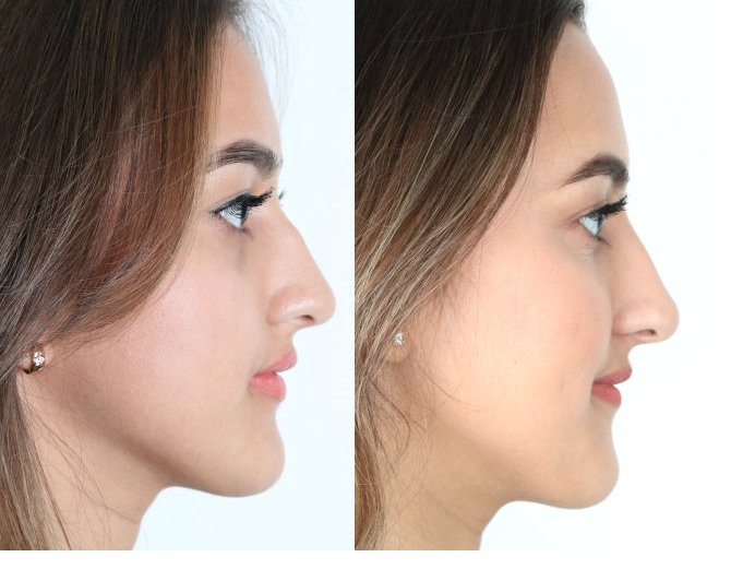 This is a fantastic article with everything patients should be aware of when considering a #nonsurgical #rhinoplasty. <a href="/Mamamia/">Mia Webb</a>   mamamia.com.au/non-surgical-n…