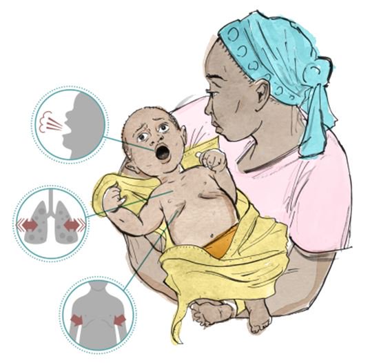 Ideas_R_US_'s tweet photo. #Hygiene  Pneumonia, is the number one cause of mortality among children under five years old, taking the lives of an estimated 1.8 million children per year.

#Ideas_R_US
@teamwinnovators
@WaterAidIndia https://t.co/axjSka2enP