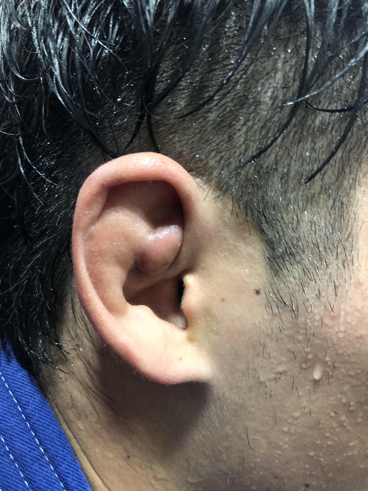 Cタケ 36 M Sic Forever 将来有望な若手と柔術 どんどん育ってきてます 耳もどんどん育ってきてますw Bjjchannel Bjj Jiujitsu ブラジリアン柔術 ぎょうざ耳 耳介血腫 T Co Yi6kyndbln Twitter Cタケ 36 M Sic Forever 将来有望な若手と柔術 どんどん育ってきてます 耳もどんどん育ってきてますw Bjjchannel Bjj Jiujitsu ブラジリアン柔術 ぎょうざ耳 耳介血腫 T Co Yi6kyndbln Twitter