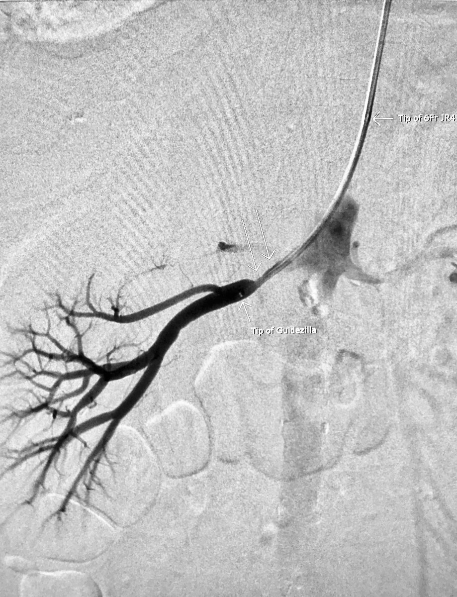 AlexCVIR's tweet image. Significant R renal artery stenosis. @ThinkRadial stenting. 6Fr JR4 guide didn’t reach so borrowed #Guidezilla from cath lab for the win. #IRad #MIIP @SIRspecialists @SIRRFS