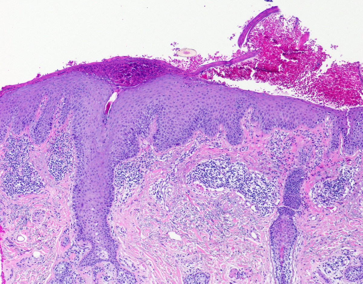 KUDermpath's tweet photo. Challenging case of pemphigus foliceus, DIF-positive. Clues include subcorneal cleavage, acrosyringeal acantholysis (arrow), subcorneal "cling-on" keratinocytes, and early spinous acantholysis (arrowed) #dermpath https://t.co/QAQCAXcjWA
