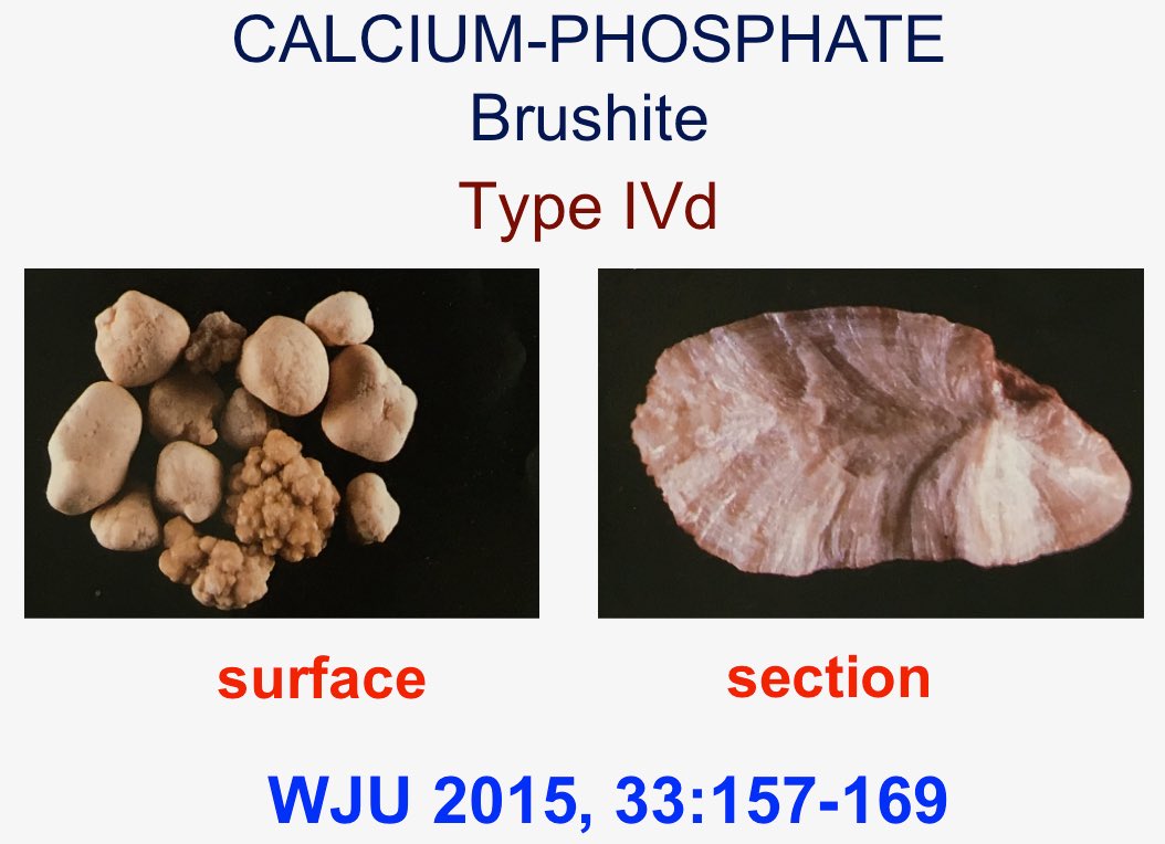 Calcium Phosphate Stone