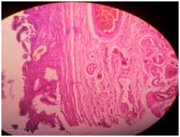 editorijcrr's tweet photo. A clinicopathological study by Manzoor et al was conducted at ASCOMS, Jammu has revealed that Ovarian carcinoma represents the sixth most common female cancer and the fourth leading cause of death due to cancers in women.
https://t.co/oT2GbnM5Cf https://t.co/hk4oXfYYHa