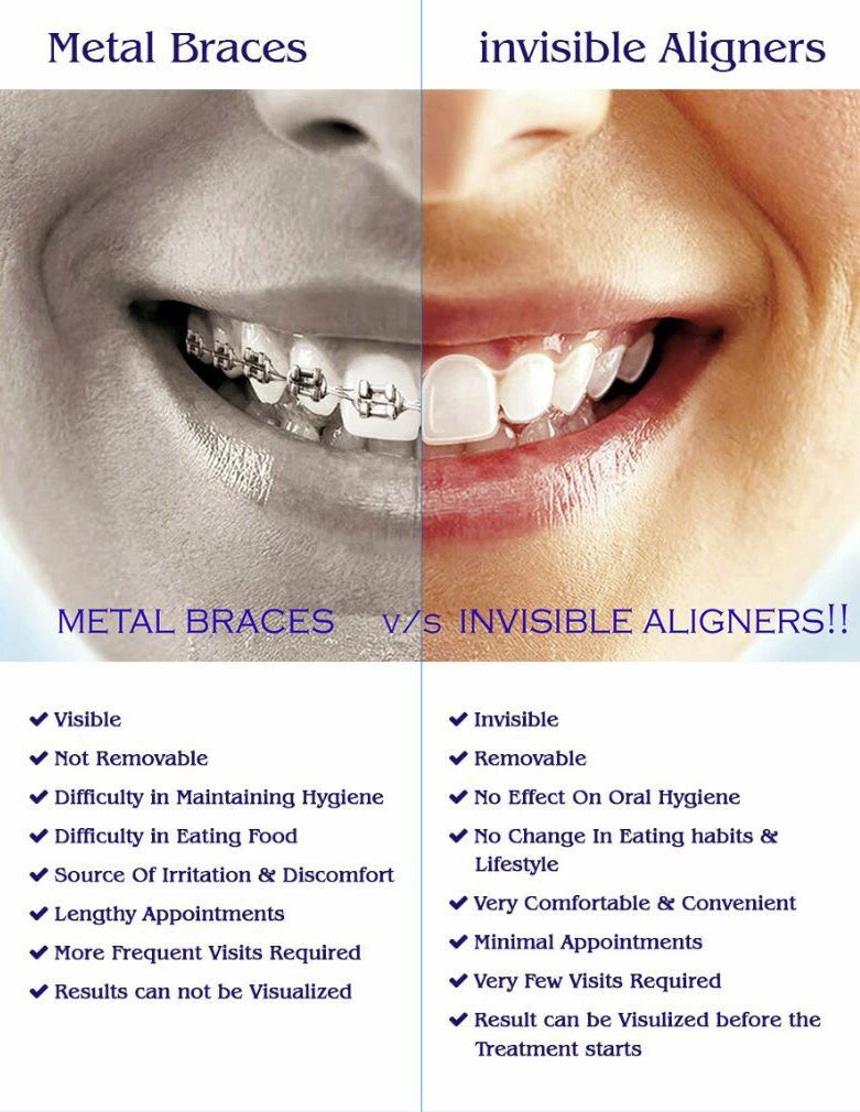 JKDENTALORTHO's tweet photo. The difference between metal braces and clear aligners .!
Visit https://t.co/EXK7sw7V7Y for more info.!
#DrKevalPatel #DrJinalPatel #JKDentalHospital #Dentist #Orthodontist #Chandkheda #Ahmedabad https://t.co/rDS9MtguJt