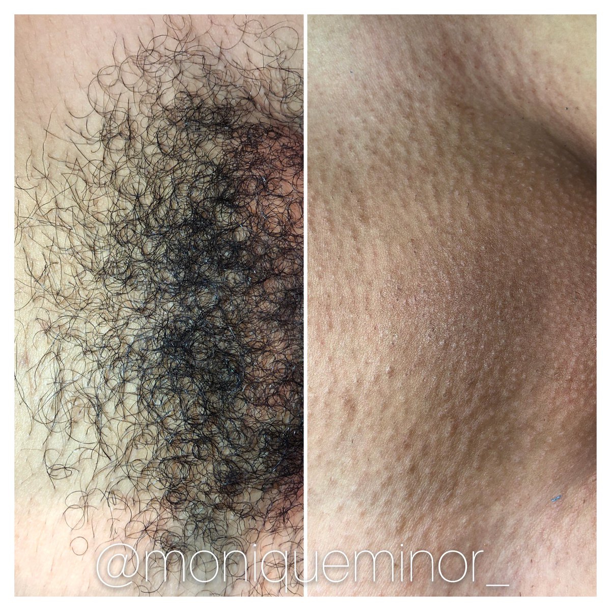 Monique Minor on Twitter: "Before and after Brazilian wax. 