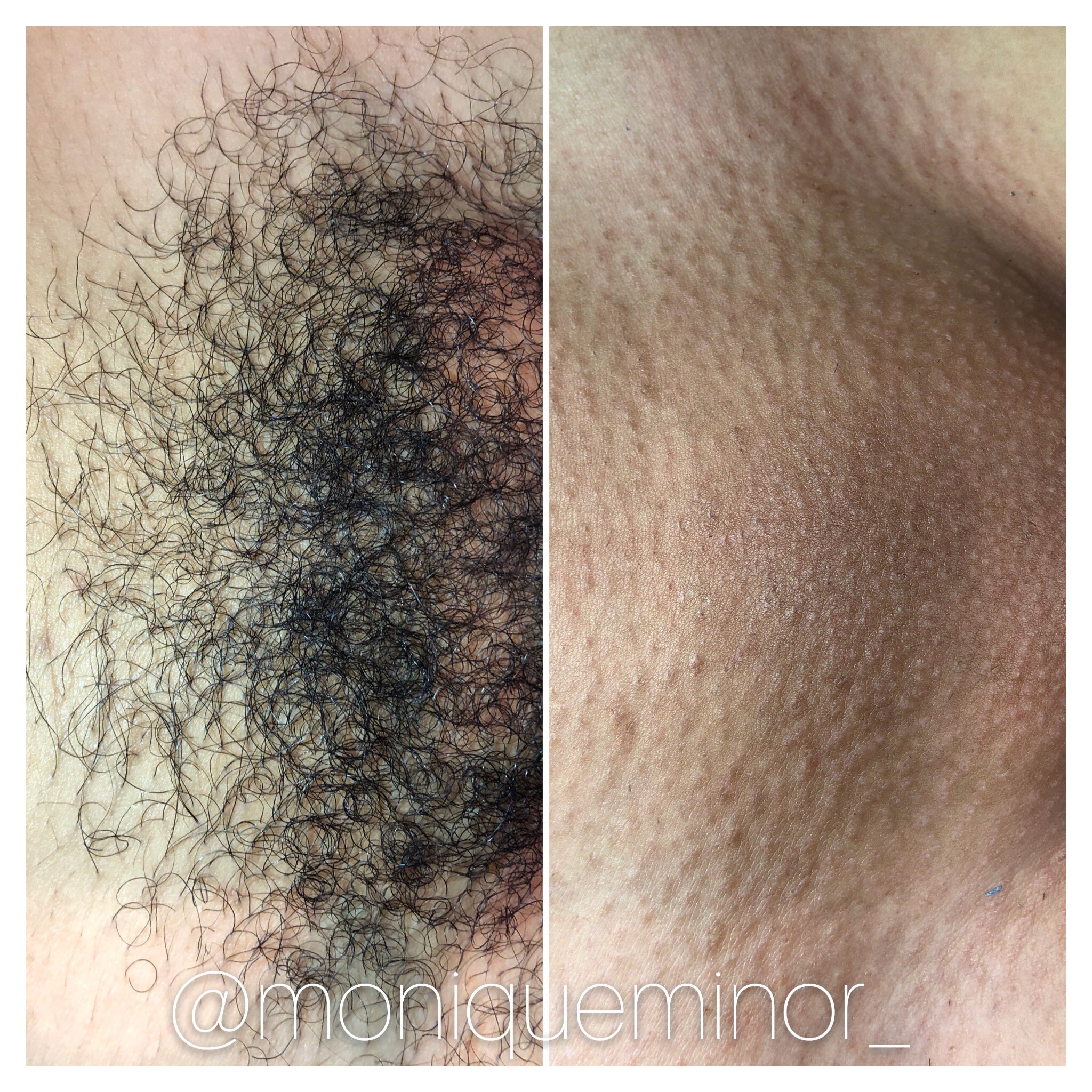 Monique Minor on X: "Before and after Brazilian wax. What a difference.  #moniqueminor #legwax #legwaxing #brazilianwax #summerready #smoothskin  #smoothlegs #underarmwax #pleasantonca #downtownpleasanton  #downtownpleasantonsalon #pleasantonsalon ...