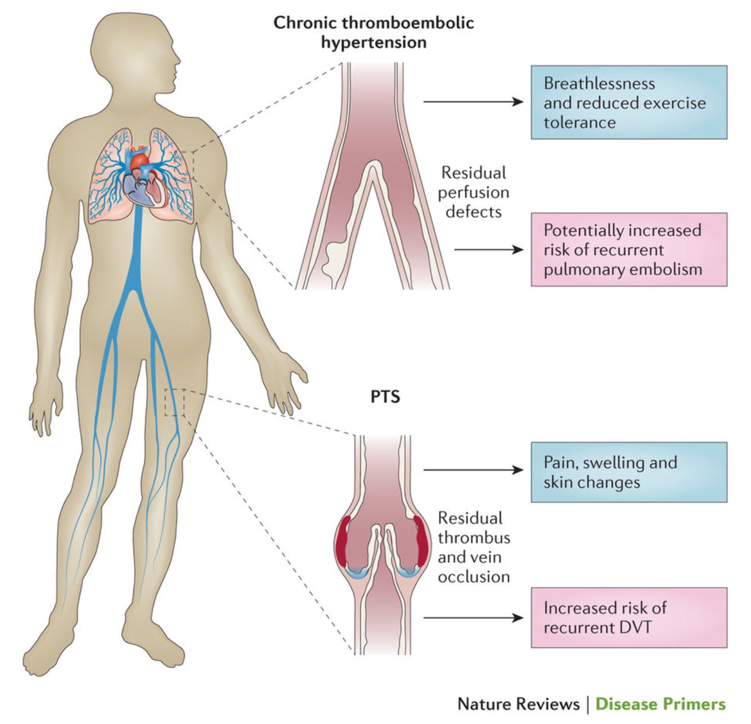 Edgar V. Lerma 🇵🇭 on Twitter "Pulmonary Embolism (PE) on CXR signs