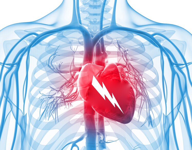 radcliffeCARDIO's tweet image. #Combat’ Approach To Cardiogenic Shock 💪🏻💙⚡️

“CS, ‘the rude unhinging of the machinery of life’, is a state of end-#organdysfunction, often complicated by a systemic inflammatory response syndrome...”

Would you like to read more?
icrjournal.com/articles/comba…

#Cardiology