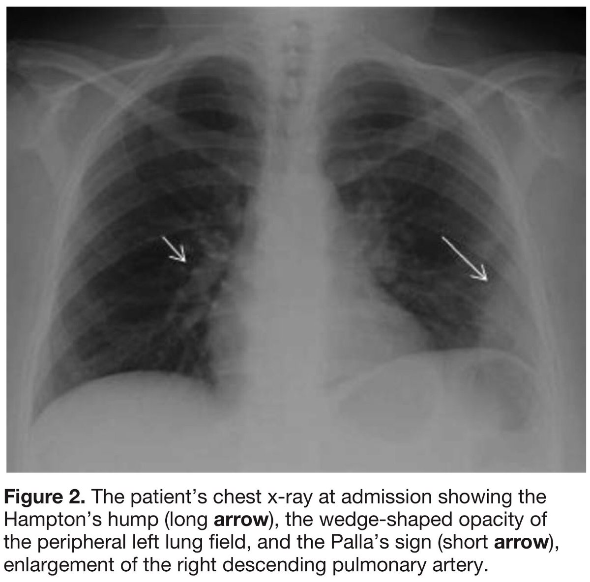 Edgar V Lerma Pulmonary Embolism Pe On Cxr Signs Hampton Hump Pleural Based Wedge Shaped Defect From Infarction Just Above The Diaphragm Palla Sign Large Right Descending