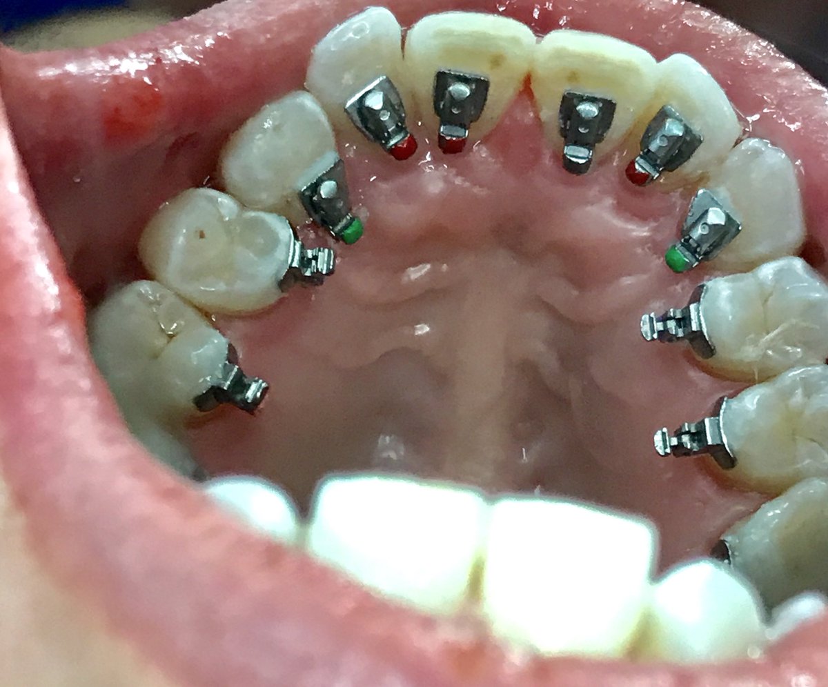 Die neuesten, unsichtbaren Zahnspangen: Dr Bonsall, Zahnchururg, Zahnarzt, Dentist, Kieferorthopaedie, Basel #zahnarzt #Basel 061 271 0604