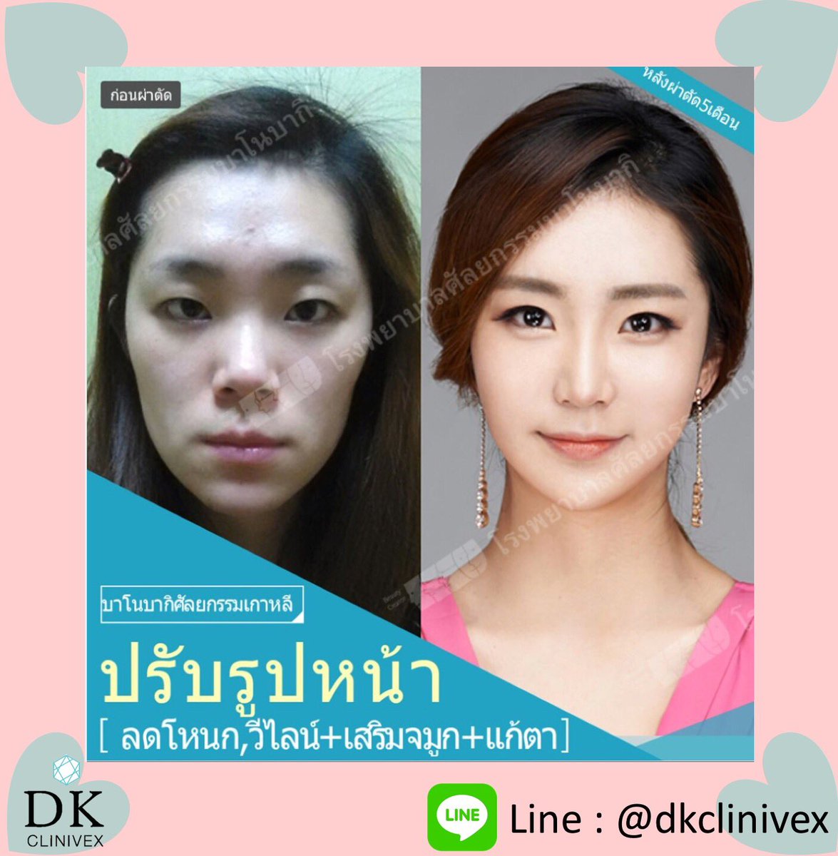 dkclinivex's tweet photo. ความสวยงามที่คุณเลือกได้ สามารถพัฒนาบุคลิกภาพที่พร้อมมอบทั้งค.มั่นใจให้กับตัวคุณ 
ปรึกษาได้ตลอด😊ทางเราพร้อมดูแลทุกท่าน และตอบคำถามให้กระจ่าง รวมทั้งเสนอราคาที่ดีที่สุดให้กับทุกท่านได้เลือกสิ่งที่ดีที่สุดสำหรับลูกค้าค่ะ

📱Line : @dkclinivex
🔮Instagram : @dkclinivex.korea https://t.co/K2rsxACz0S