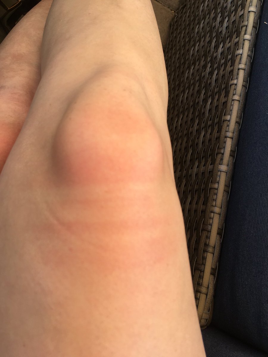 Wicked_chaser's tweet photo. The number one reason why the ripped jean trend is not good for summer! #tanfail #notmyknee https://t.co/txYf0Raqlv