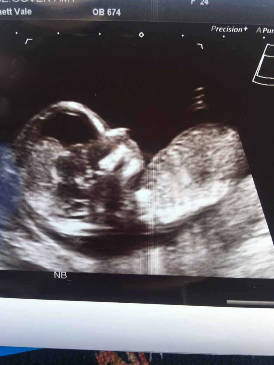amykvdr's tweet photo. Bubble was very active 😂
Apparently now measuring at 13 weeks and 3 days rather than 13 and 1, is estimated due date is November 30th, but not ruling out December 2nd since it’s only two days difference. https://t.co/M6HZ7qPqY2