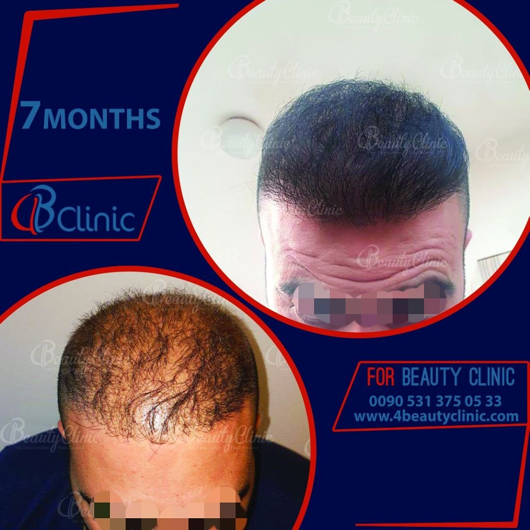 نتائج مضمونة مع شهادة الضمان 
نتائج زراعة الشعر في الشهر السابع 
#قبل #بعد #زراعة_الشعر #زراعة_الأسنان #اللحية 
للتواصل :00905313750533