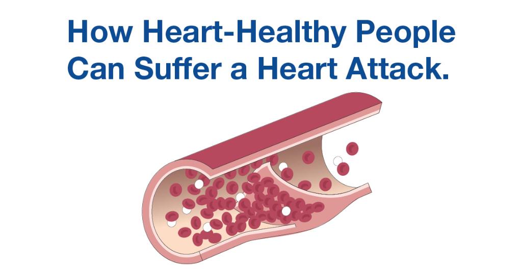 #SpontaneousCoronaryArteryDissection (SCAD) can slow or block blood flow in the heart, causing a heart attack. People who develop SCAD are often healthy women in their 40's and 50's. Learn more. mayocl.in/2Ic43nC