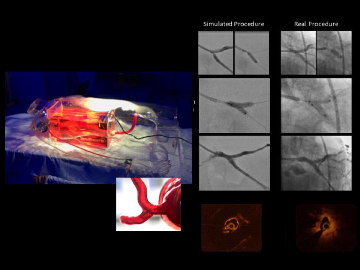 Manuel_O_Santos's tweet photo. Check out our case of patient-specific 3D printing simulation for complex PCI! @CE_Guerreiro
@DrFerNunez @AlfredoRedondoD
@fergomezp23 @Avila_MD @rladeiraslopes
@MartaTavS
@QuinaCatarina @RaquelBaggenS
@AnaRitaFrancis1 

https://t.co/j9xZQm9yzZ https://t.co/xVHpejMCRx