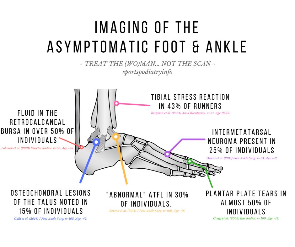 Ian Griffiths (@sports_pod) on Twitter photo This one inspired by <a href="/AdamMeakins/">The Sp⚽️rts Physio</a>; things seen on scans in those that hurt are often also seen in those that don’t (the foot & ankle edition): This one inspired by <a href="/AdamMeakins/">The Sp⚽️rts Physio</a>; things seen on scans in those that hurt are often also seen in those that don’t (the foot & ankle edition):