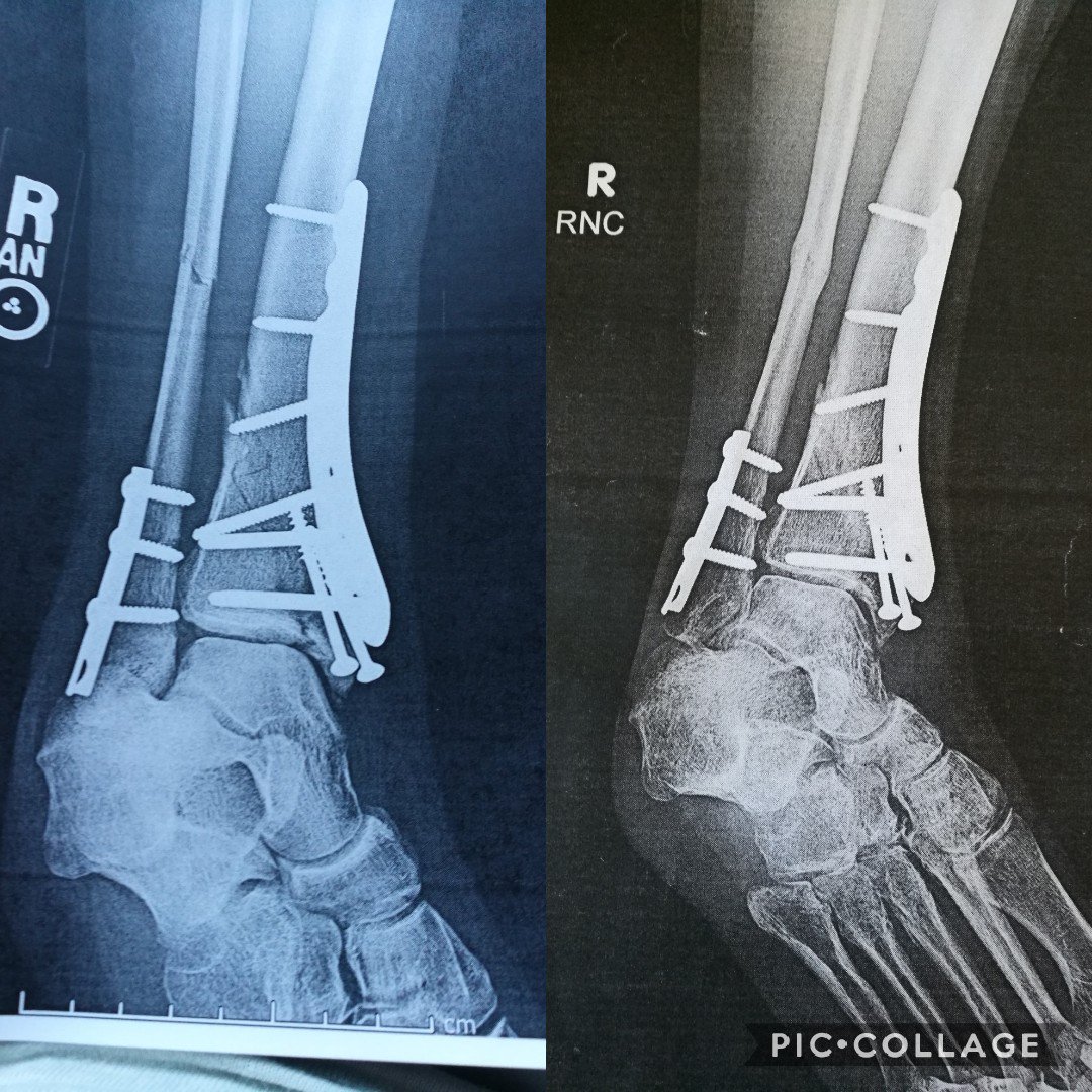 sweetpearambles's tweet image. 6 months post op today. It has been the longest and shortest 6 months ever. I'm still amazed that it happened. #tibfib #ankle #postop #orif #broken