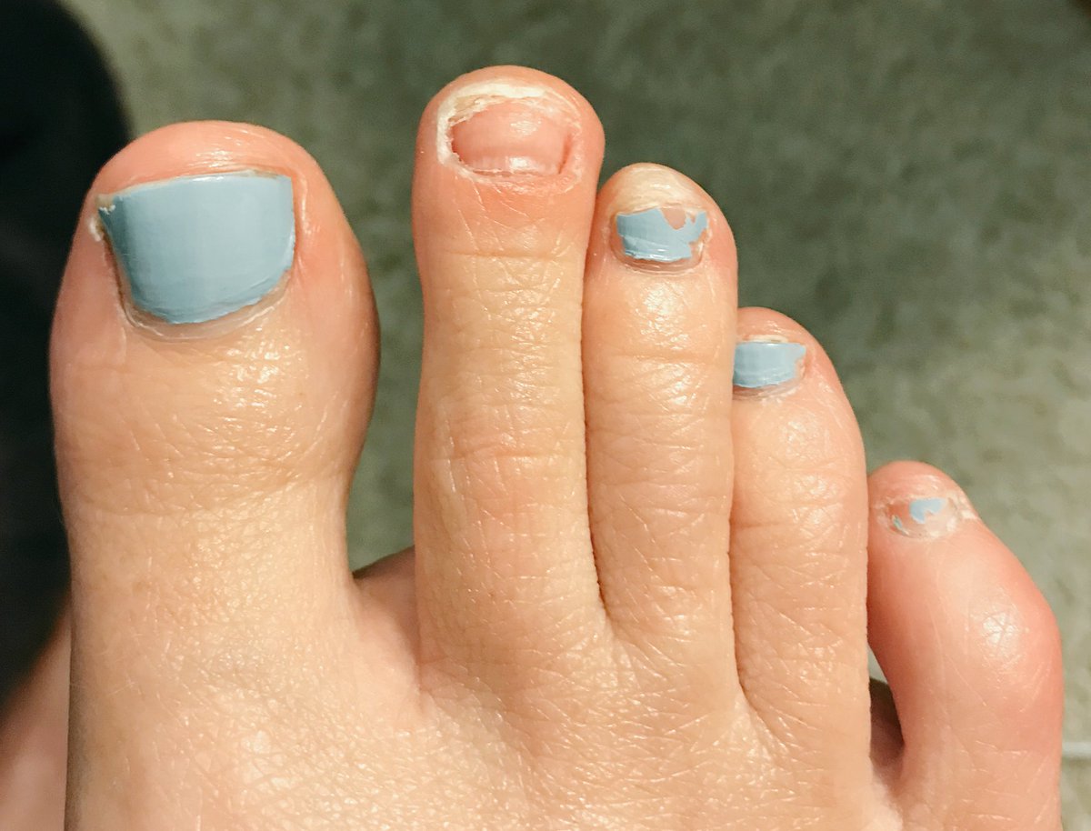 heatheraubrey's tweet photo. After running the 3-way Pig weekend and Ragnar Trail the weekend after, that toenail finally came off. Isn’t this some sort of runner milestone? #kindagross #kindaproud https://t.co/wRwRIkywEO