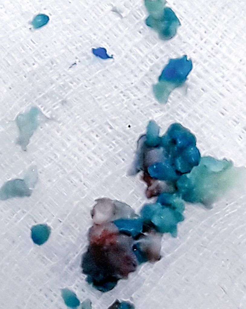 sportsurgeonng's tweet photo. Transforaminal endoscopic lumbar discectomy for Cauda equina syndrome from L4/5 disc prolapse .#stitchlesssurgery #backpain @drdo https://t.co/XvDMsHnZWY