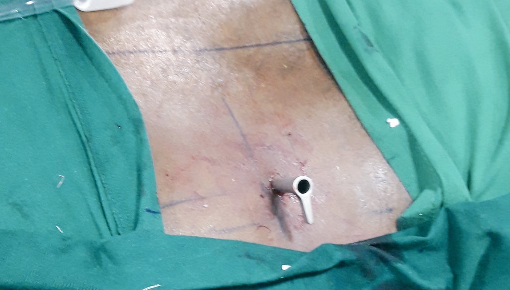 sportsurgeonng's tweet photo. Transforaminal endoscopic lumbar discectomy for Cauda equina syndrome from L4/5 disc prolapse .#stitchlesssurgery #backpain @drdo https://t.co/XvDMsHnZWY