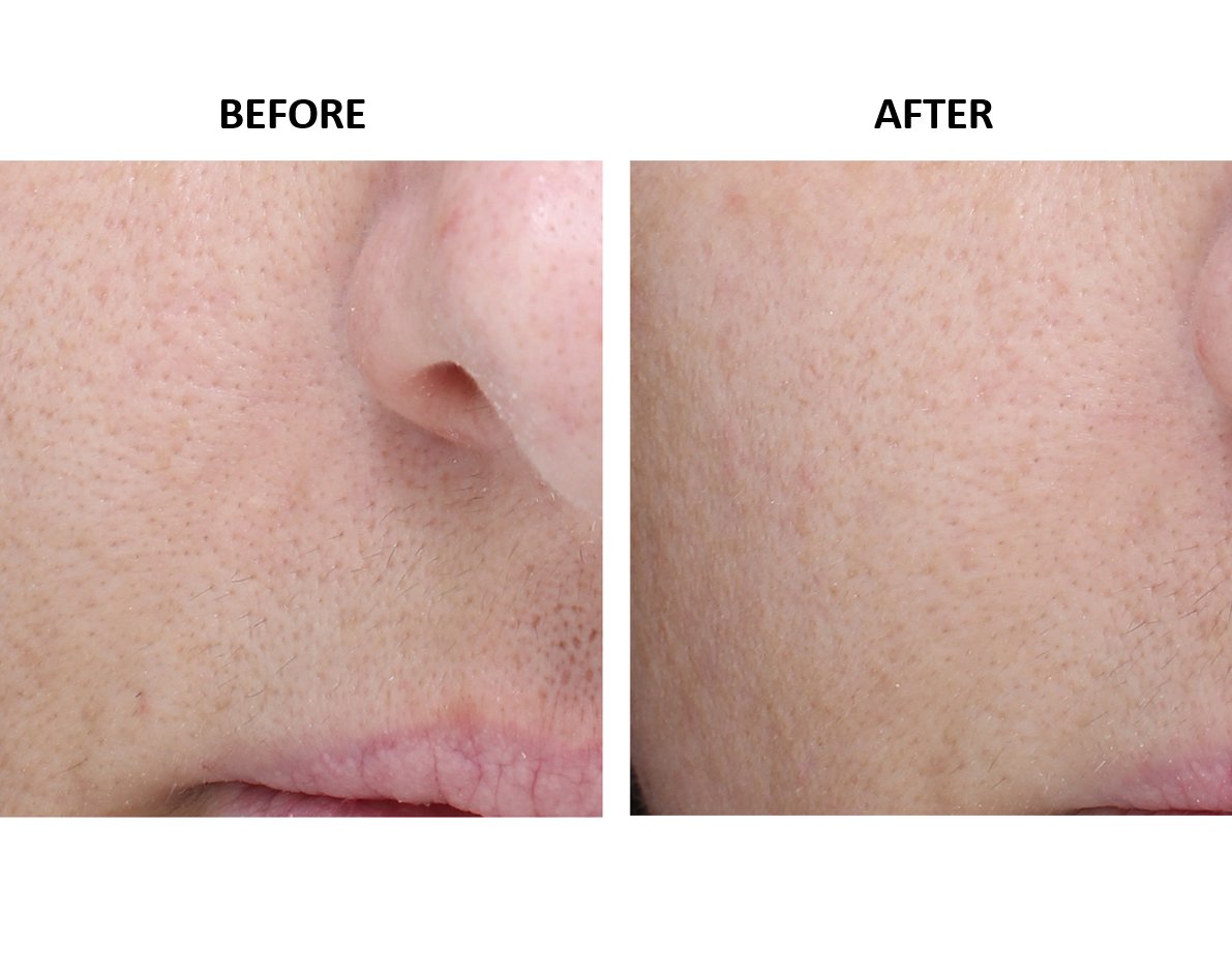 nowmi_treatment's tweet image. Do you suffer from large pores?   With the NowMi treatment, you can get rid of large pores in 5 minutes! As you can see from the picture below, after only 6 treatments the pores were reduced and the skin texture improved significantly. For more results: ow.ly/M0TL30jE0eA