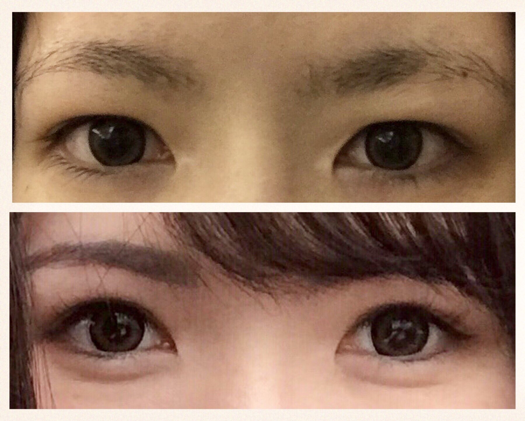 Aちゃん ところで眉下切開とてもおすすめです 私は瞼がとても重い奥二重 で 埋没してもすぐ重たい瞼が被ってきてしまってたんですが 眉下切開をしたら瞼がすっきりして目がクリクリだねってよく言われるようになりました めっちゃ調べたので心配だった Aちゃん ところで眉下切開とてもおすすめです 私は瞼がとても重い奥二重 で 埋没してもすぐ重たい瞼が被ってきてしまってたんですが 眉下切開をしたら瞼がすっきりして目がクリクリだねってよく言われるようになりました めっちゃ調べたので心配だった