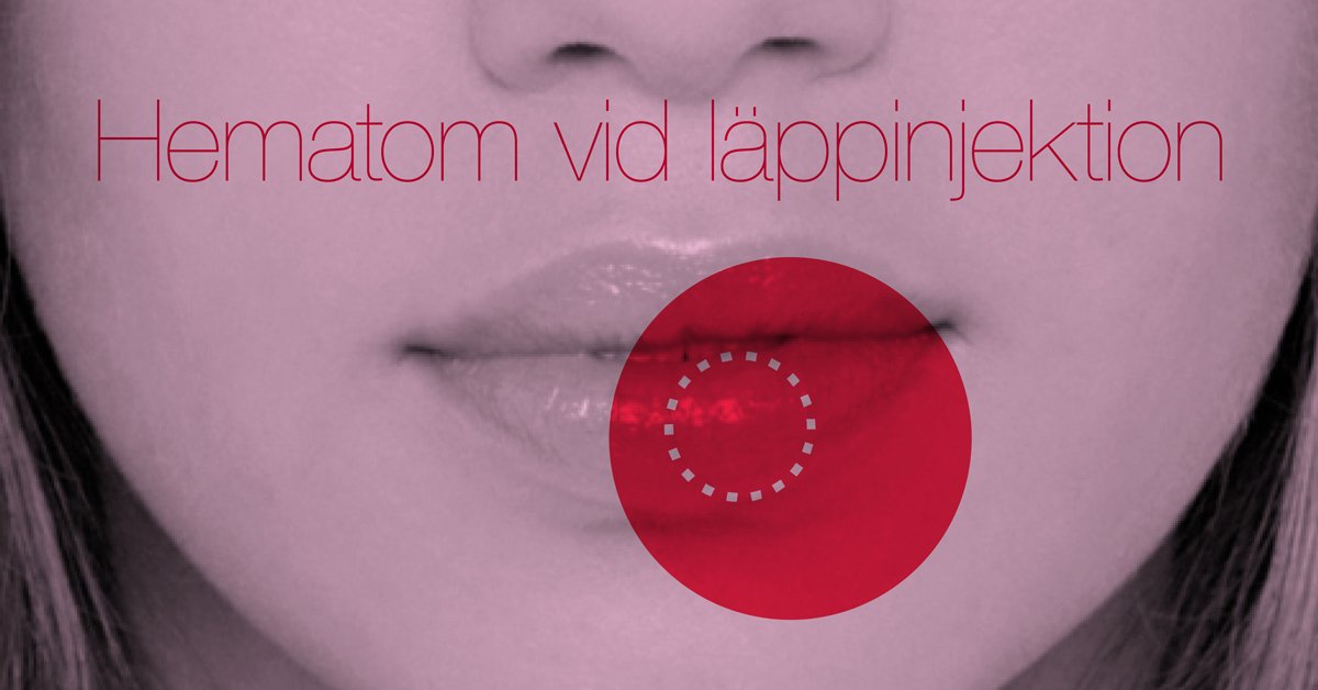 MediceraSverige's tweet photo. Då och då märker många erfarna #läkare att vissa #patienter blöder mycket i läppen vid #fillerinjektioner.
Läs varför: https://t.co/gBasQsgT2X 
#estetik #filler #fillers #hudfiller #hyaluronsyra #infuzion #infuzionsystem #läppfiller #läppförstoring #läppinjektioner #hematom https://t.co/vcQGPnwVFK