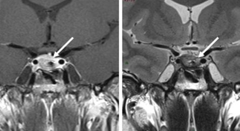 EDMCaseReports's tweet image. Recurrent pituitary abscess: case report and review of the literature by Raluca Maria Furnica et al ow.ly/blTO30jWWLh