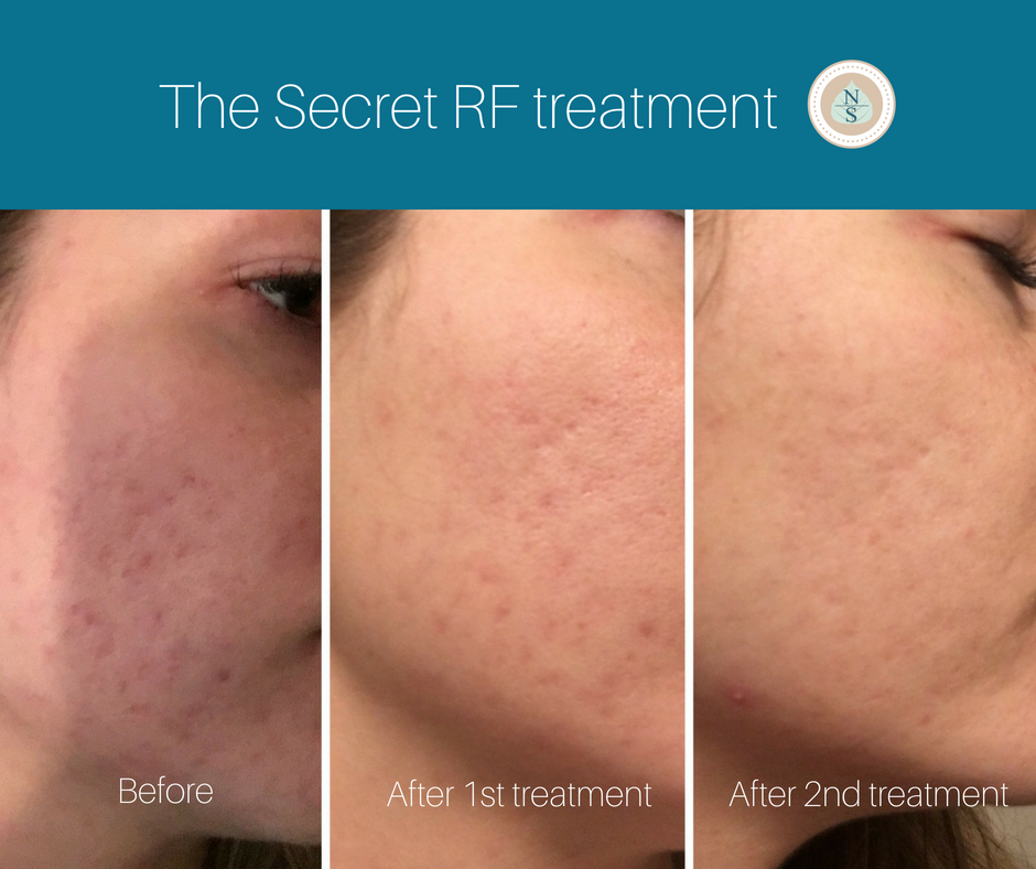 Check out these amazing results after only two treatments. Our Secret RF treatment can significantly improve acne scars, stretch marks, wrinkles, loose skin, and enlarged pores.
