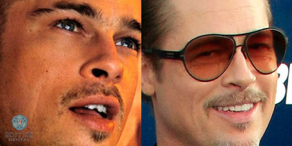 Brad Pitt Chipped Tooth