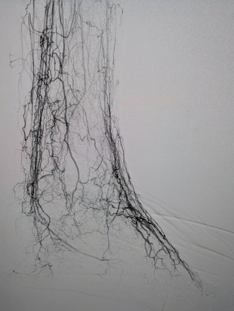 LessneVIR's tweet image. Hello PT, my old friend #OrbitalAtherectomy &amp;amp; #PTA to inc plantar perfusion in pt w forefoot ulcer #MyLegMyLife @CLTRadiology #IRad